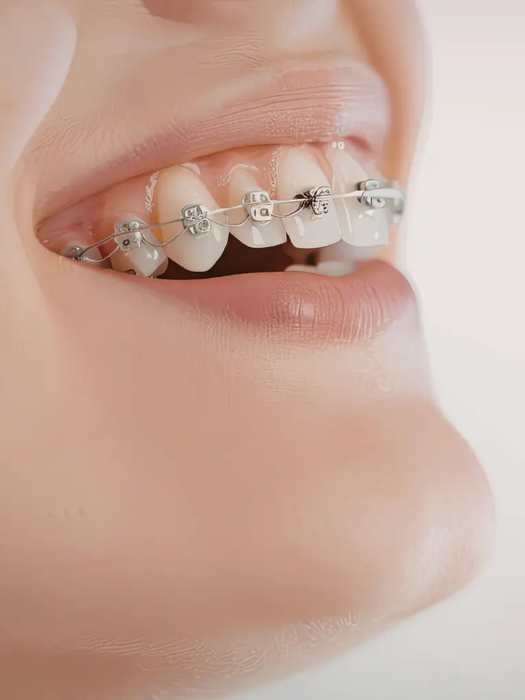 Orthodontic Treatment at TeethTime