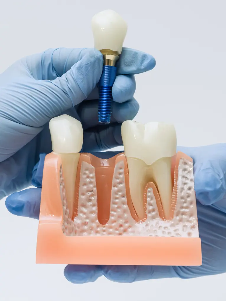 Dental Implant Treatment